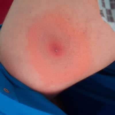 A 'Bullseye' rash
