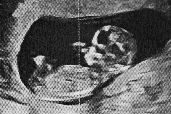 Pregnancy scan image