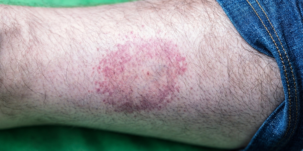 bullseye rash